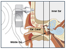 Diagram of BAHA processor and parts of the ear