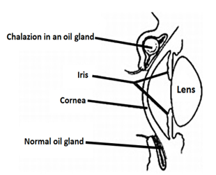 Labeled parts of the eye with Chalazion in an oil gland