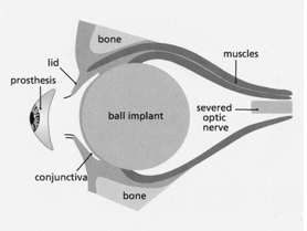 Implant in socket and showing prosthesis before insertion