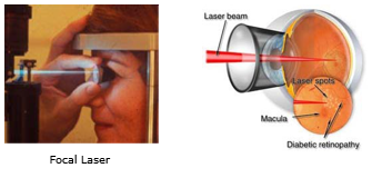 Focal Laser and Laser beam through the eye