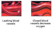 Leaking blood vessels and closed blood vessels 