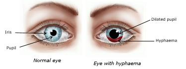 Images of a normal eye and one with Hyphaema (bleeding)