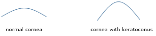 Flat shaped curve for normal cornea and bell shaped cornea for cornea with keratoconus.