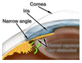 Diagram of parts of the eye showing the obstruction of the normal aqueous flow