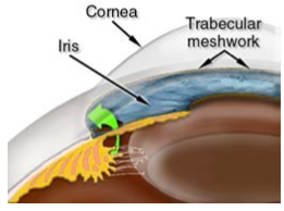 Diagram of the inside of the eye showing where the laser creates an opening in the iris allowing better drainage through the trabecular meshwork.