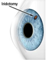 Diagram of the outside of the eye showing where the laser (iridotomy) is positioned.