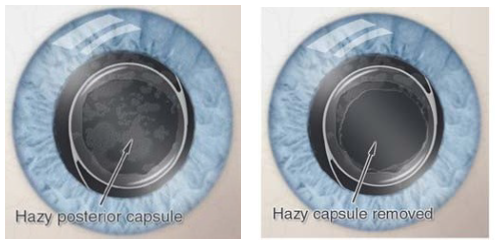 Image of two lens capsules, one is hazy and the other shows a clear lens after the hazy capsule is removed.