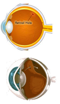 Two diagrams of an eye showing a hole in the retina (sensitive layer that lines the inside of the eye).