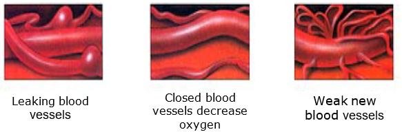 Three diagrams showing 1) leaking blood vessels, 2) closed blood vessels and 3) weak new blood vessels