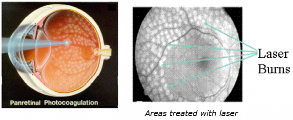 Two diagrams showing an eye that has received pan retinal photocoagulation treatment.