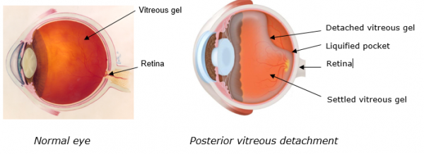 Two diagrams of a cross-section of the eyeball, one showing normal vitreous gel and the other showing vitreous gel detachment leading to a liquified pocket.