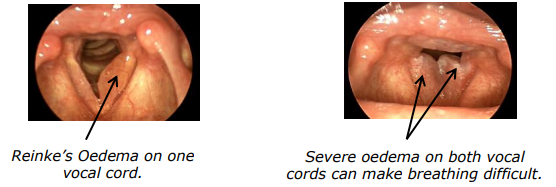 Figures of Reinke's Oedema on vocal cords.