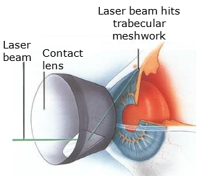 afijo Extremistas Subordinar Selective Laser Trabeculoplasty (SLT) – The Royal Victorian Eye and Ear  Hospital