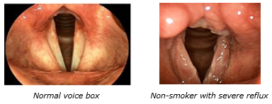 Normal voice box and affected voice box which appears red and swollen.