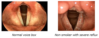 acid reflux throat