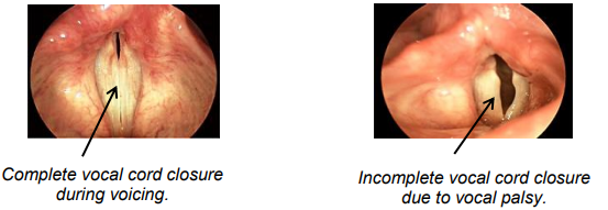 Figure of two vocal cords, the first in a normal closed position, the other slightly open due to vocal palsy.