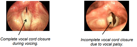 Vocal Cord Palsy The Royal Victorian Eye and Ear Hospital