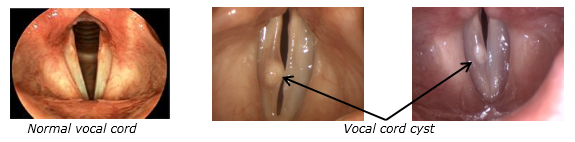 Image of 3 vocal cords. The first is normal, the second and third show vocal cords with cysts.