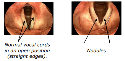 Figure of two vocal cords, the first illustrates normal vocal cords in an open position with straight edges, the second illustrates where the nodules are located.
