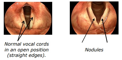 vocal nodules and singers