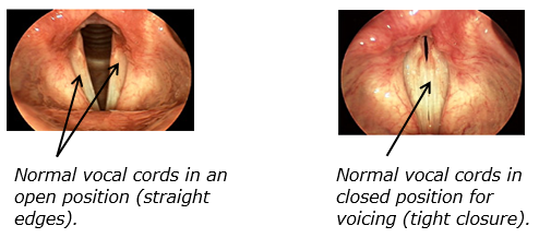 Normal vocal cords in open and closed positions