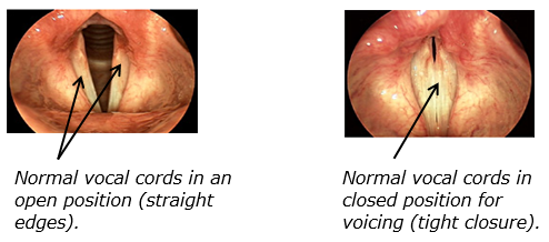 Dysphonia Voice Disorder The Royal Victorian Eye and Ear Hospital