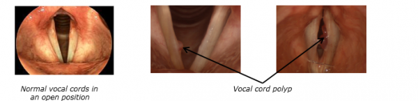 Vocal cord polys image