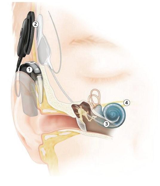 A diagram of the inside of an ear equipped with a cochlear implant system