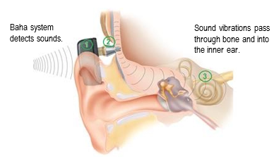 Figure 1 Transmission of sound using the Baha. Baha system detects sounds and sound vibrations pass through bone and into the inner ear.