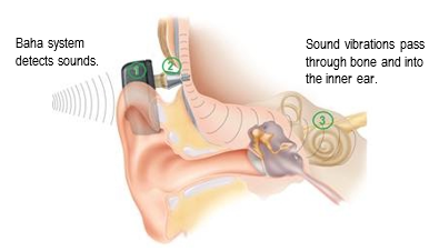 Sound through bone online conduction