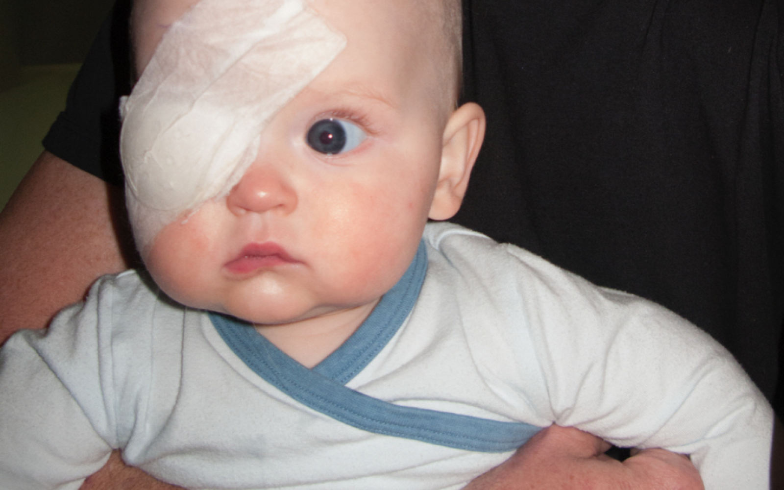 A baby wears a medial eye patch